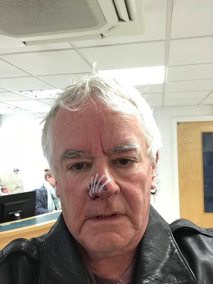 Saxon: Nigel Glockler wurde bei Hundeangriff die Nase halb abgebissen