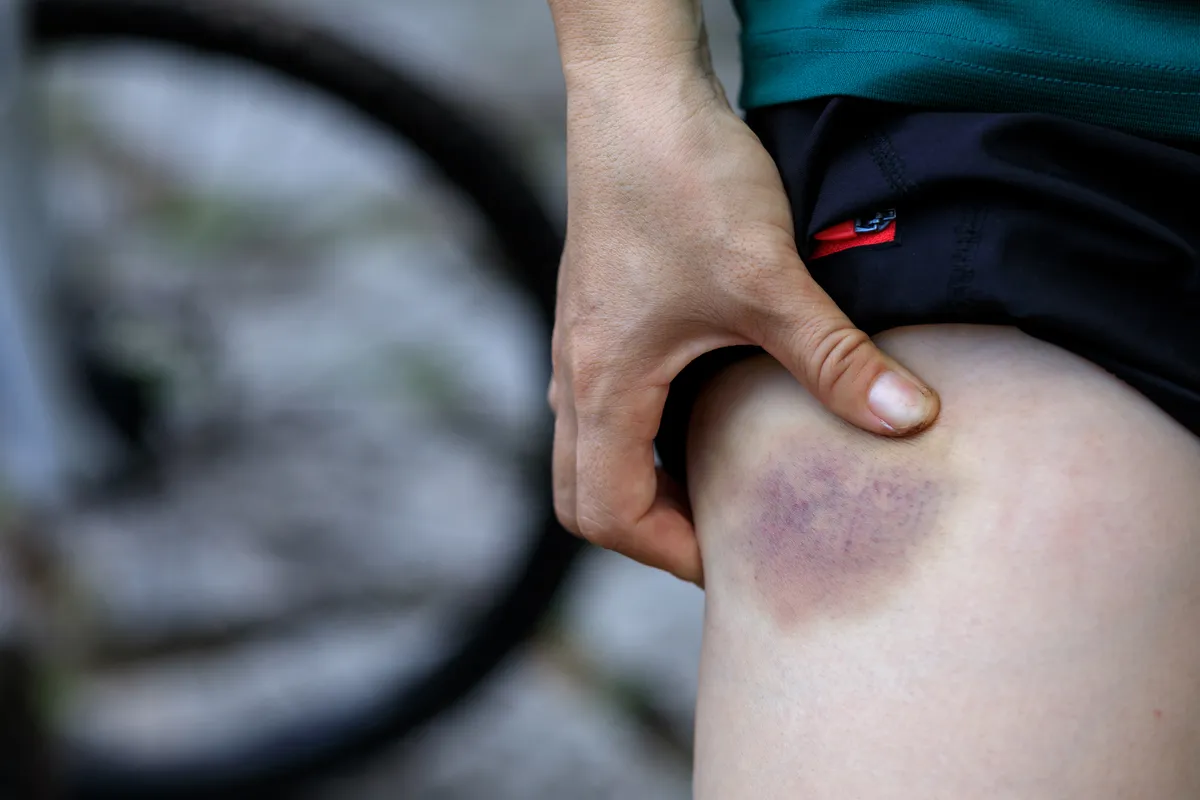 Person with bruised leg caused by bike accident
