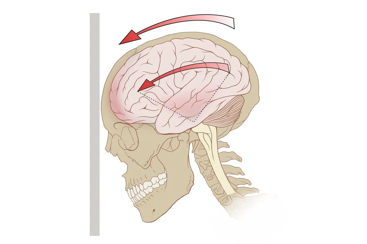 Illustration showing the mechanics of concussion in human brain