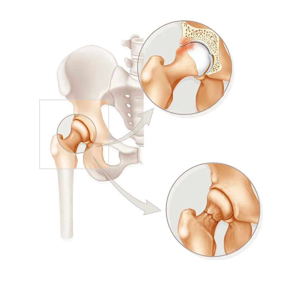 Illustration of the two pathologies in the hip : -femoroacetabular impingement : presence of a bump of the upper front part of the femoral neck, and/or a cup that overly covers the top and exterior of the femur. -fracture of the femoral neck. (Photo by: BSIP/Universal Images Group via Getty Images)