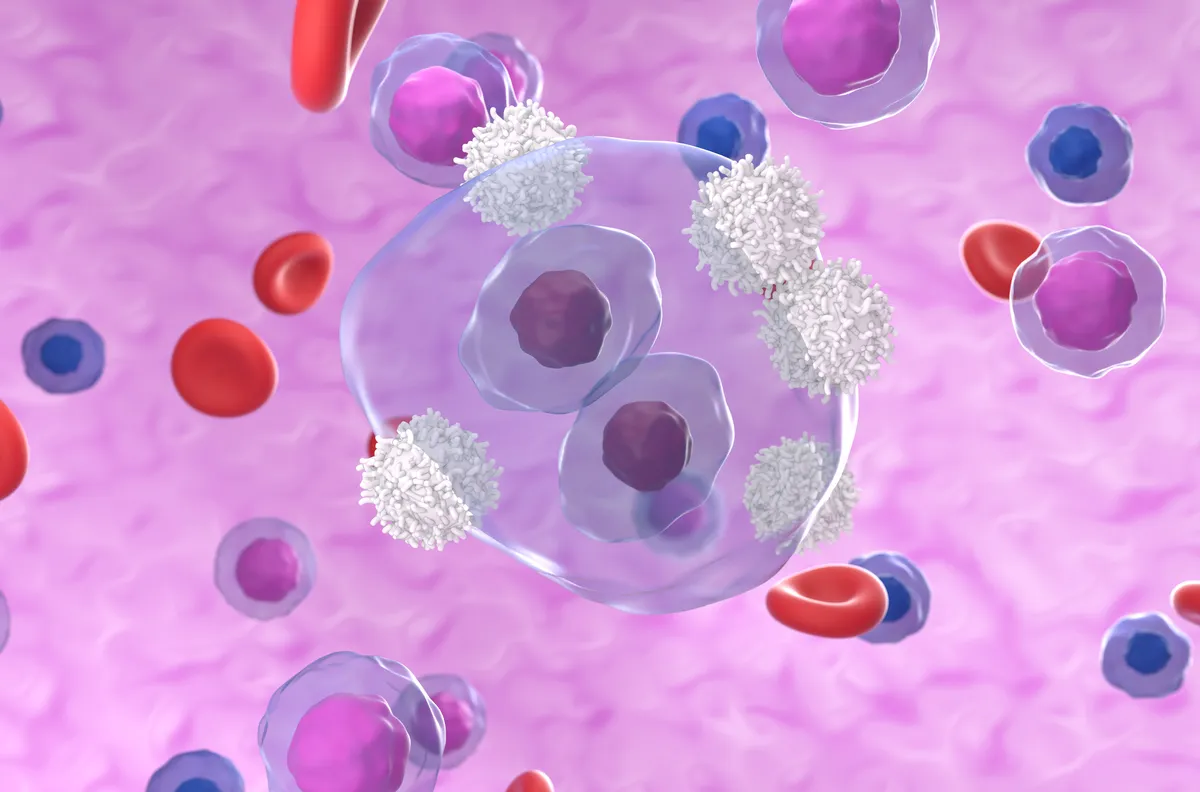 Illustration of T cell white blood cells attacking a Hodgkin's lymphoma cell. Hodgkin's lymphoma, or Hodgkin's disease, is a malignant (cancerous) tumour (neoplasm) that develops in the lymphoreticular system and originates from lymphocyte white blood cells. It is differentiated from other lymphomas by the large multinucleated cells (Sternberg-Reed cells, centre). T lymphocytes, or T cells, are a type of white blood cell and a component of the body's immune system. They recognise a specific site (antigen) on the surface of a pathogen or cancerous cell, bind to it, and attract antibodies or cells to eliminate it