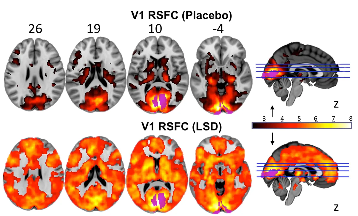 This image shows the marked difference in brain activity when the under the influence of LSD (© Imperial/Beckley Foundation)