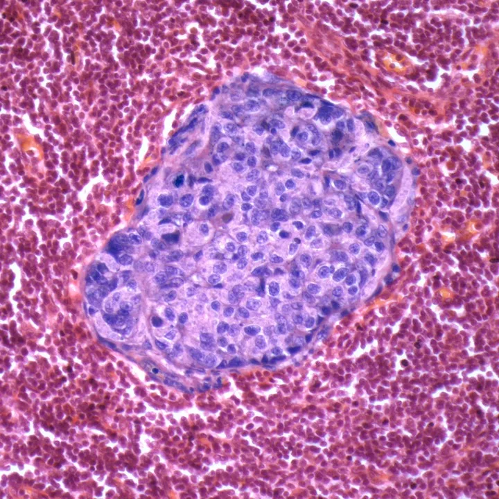 Light micrograph of a section through a lymph node showing a malignant (cancerous) tumour (purple) that originated in the breast. Magnification: x200 when printed at 10 centimetres wide. Credit: PHOTO QUEST LTDLight micrograph of a section through a lymph node showing a malignant (cancerous) tumour (purple) that originated in the breast. © PHOTO QUEST LTD/Getty