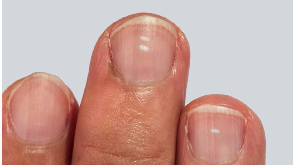 Blue fingernails - The symptom unpacked
