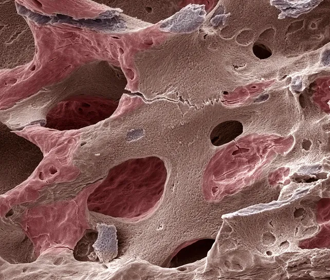 Scanning electron micrograph (SEM) of human bone with osteoporosis © Science Photo Library/Getty Images