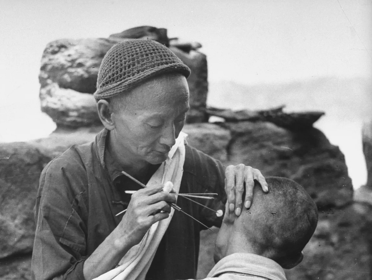 A Chinese man performing acupuncture on a man's ear © Carl Mydans/The LIFE Picture Collection/Getty Images