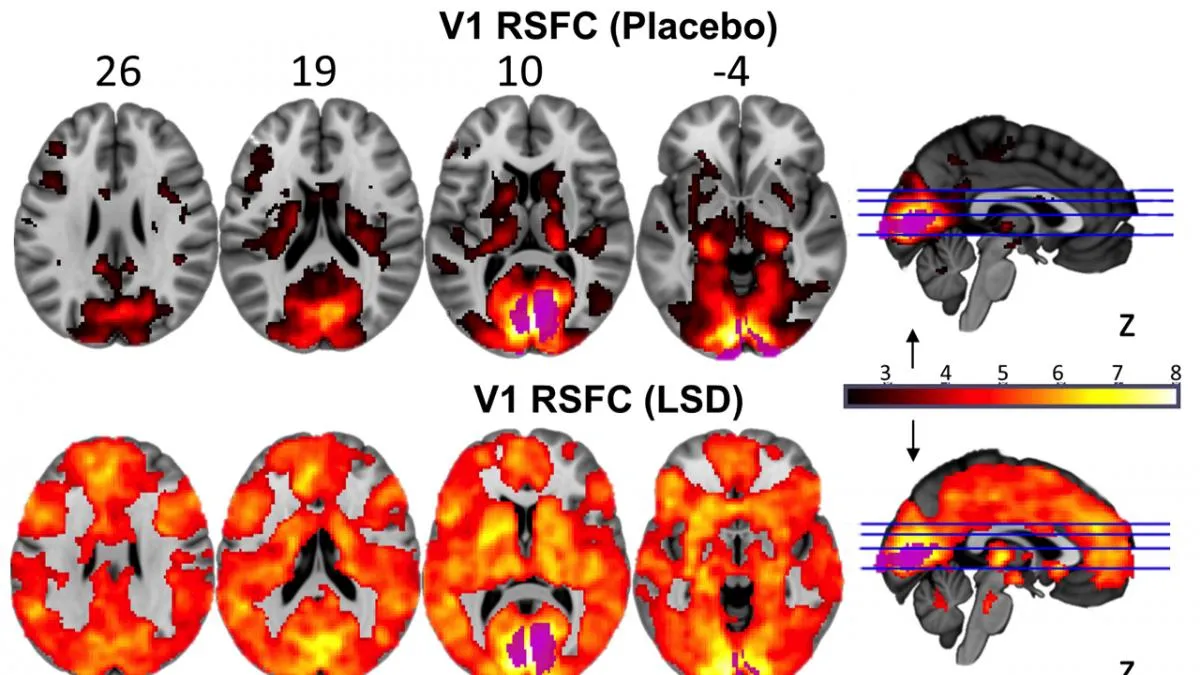 This image shows the marked difference in brain activity when the under the influence of LSD (© Imperial/Beckley Foundation)