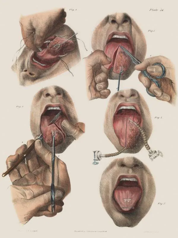 p110 cancer of the tongue