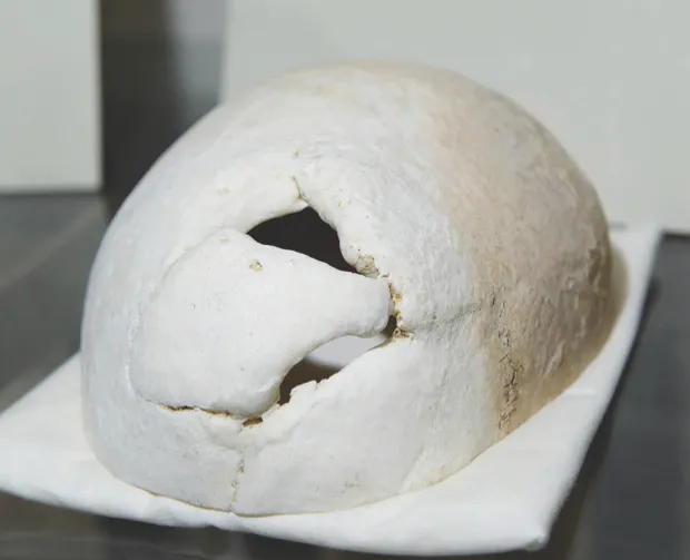 Gage’s skull is on display in Harvard Medical School. The hole is where the iron rod exited through the top of his skull © Alamy