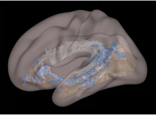 This lateral brain image of a child exposed to significant screen time shows lower level levels of white matter structural integrity. These effected areas are in blue © Cincinnati Children's