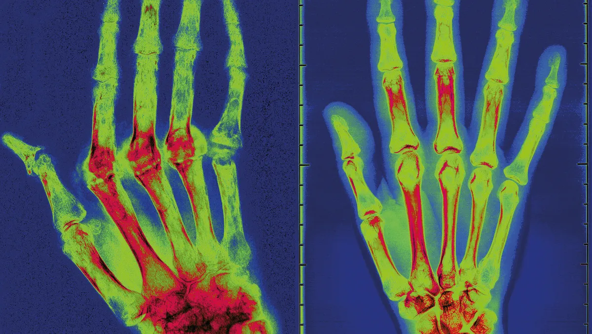 LEFT: Better knowledge of the ENS could help us treat conditions such as arthritis