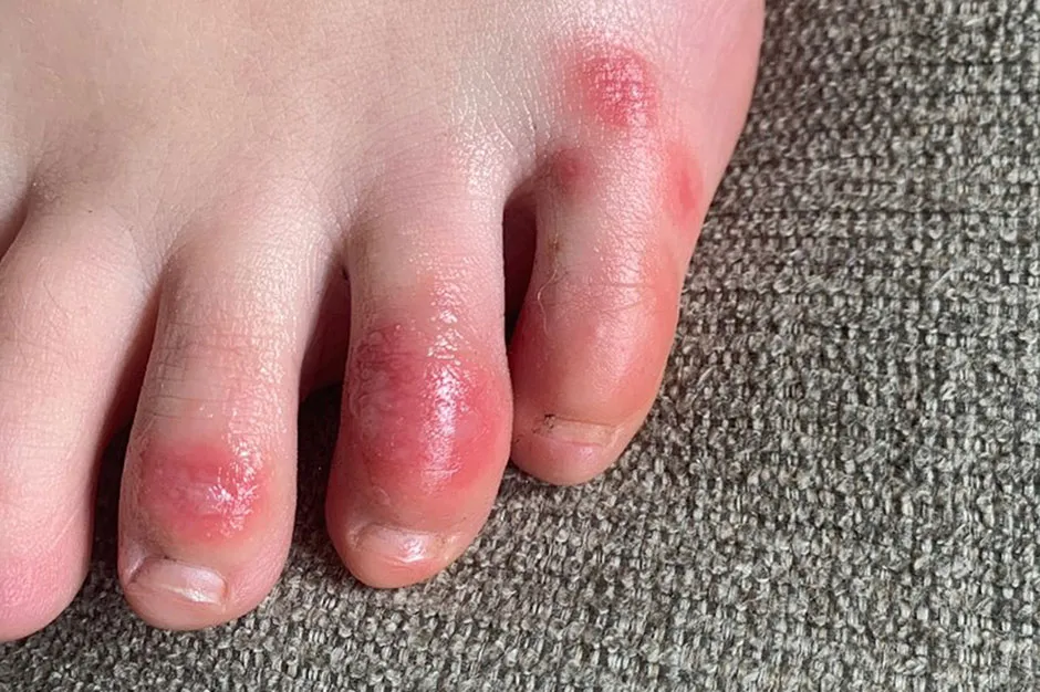 'COVID toe' © Dr Amy Paller/Northwestern University via AP
