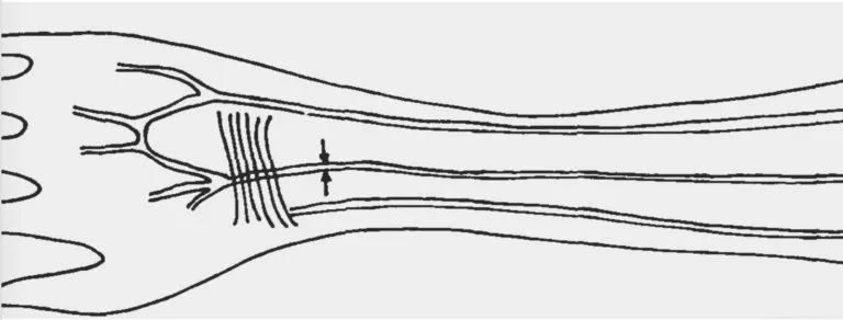 Sketch of median artery vessel which supplies blood to the human forearm and hand © Professor Maciej Henneberg