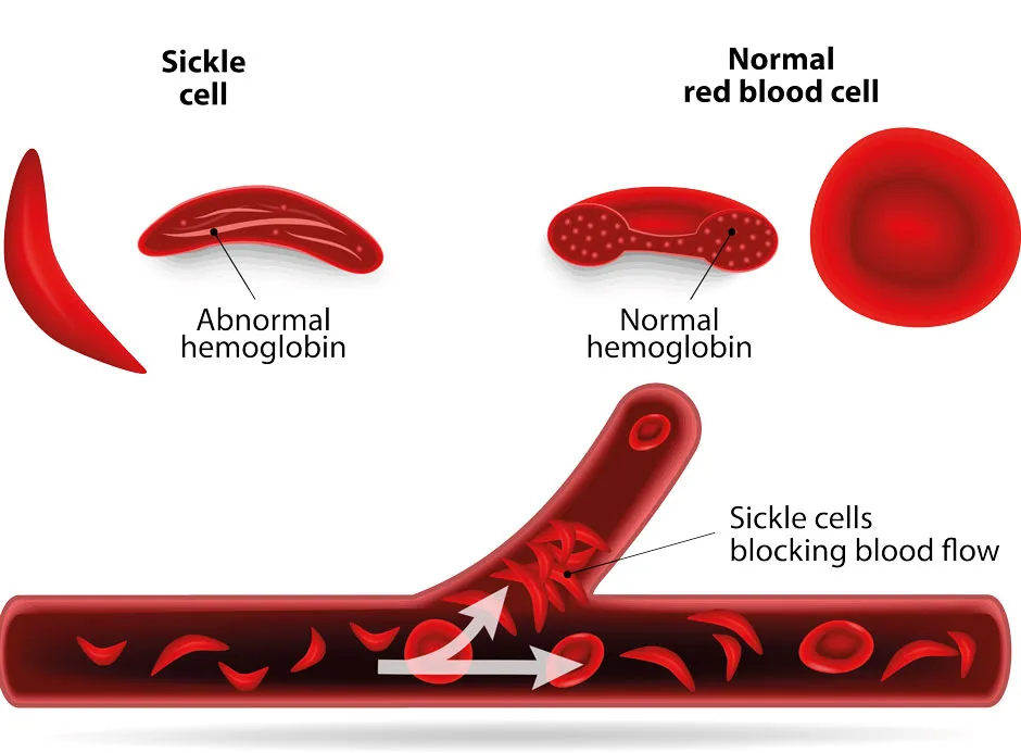 How sickle cell disease can block circulation © Getty