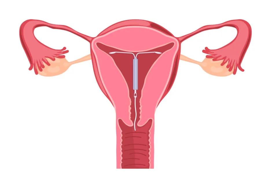 The IUD is inserted into the uterus, releasing copper that kills sperm © Getty Images