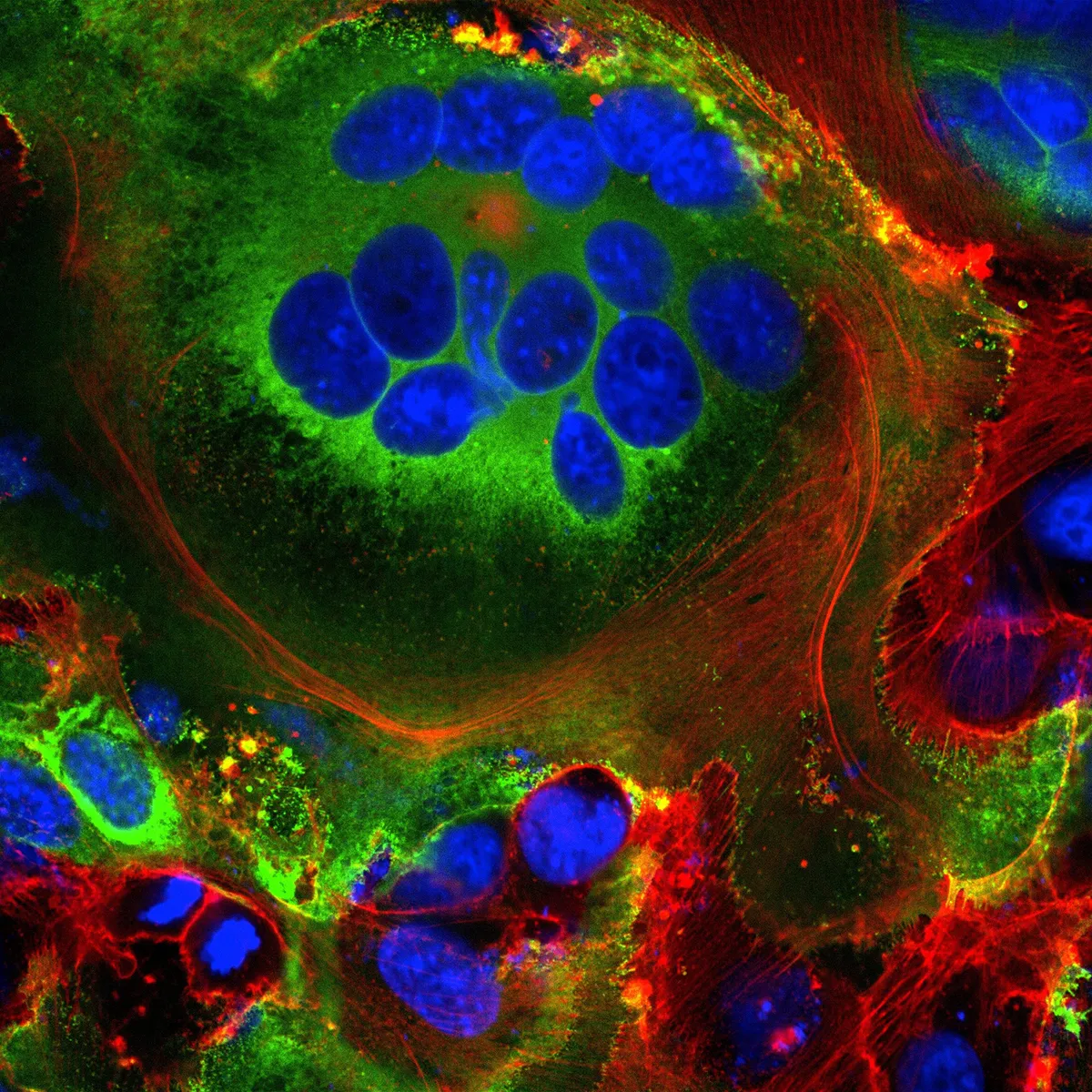 multiple lung cells that have joined together to create large virus-infected cells. This abnormal cell fusion is triggered when the COVID-19 virus infects healthy cells, causing them to become infected and display the COVID-19 spike protein on their surface. This prompts a series of events that causes infected cells to reach out and fuse with neighbouring cells. Credit: Mauro Giacca, King’s College London, British Heart Foundation – Reflections of Research