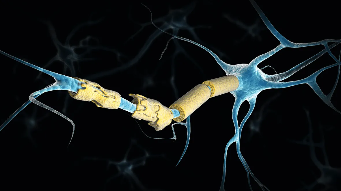 MS nerve cell with damaged myelin