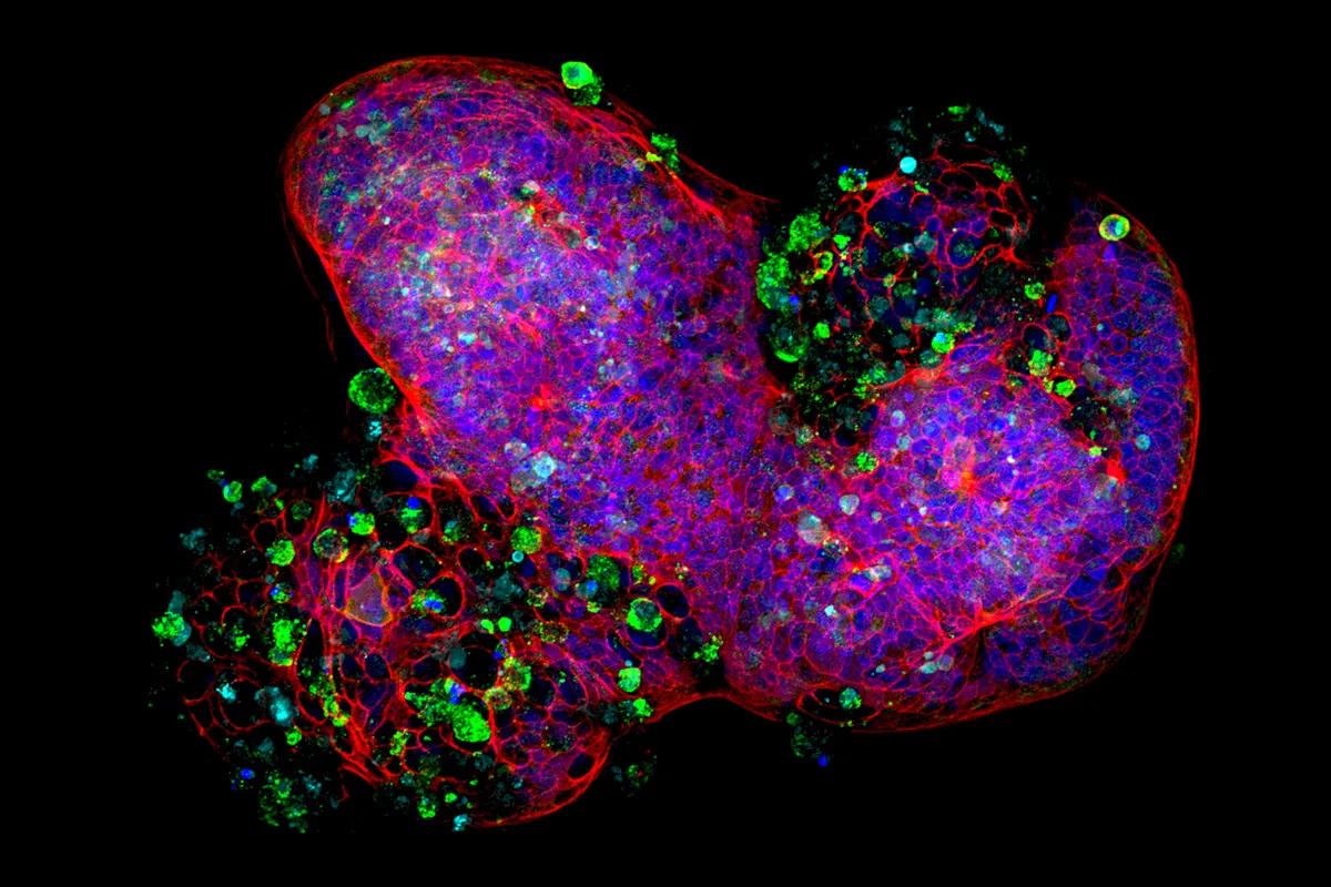 'SARS-CoV-2 infected ‘mini-stomach’ was submitted by Dr Giovanni Giuseppe Giobbe, a Senior Research Associate at UCL GOS ICH. This image shows a 'mini-stomach', also known as an organoid, which are 3D structures of cells grown in a lab that mimic the behaviour of organs found in the body. The cells highlighted in green in this 'mini- stomach' are infected with the SARS-CoV-2 virus. These 'mini-stomachs' allow us to study diseases in even more detail than before. They provide scientists with invaluable tools to study how our human organs function, both when they are healthy, and when they impacted by disease, like Covid-19.