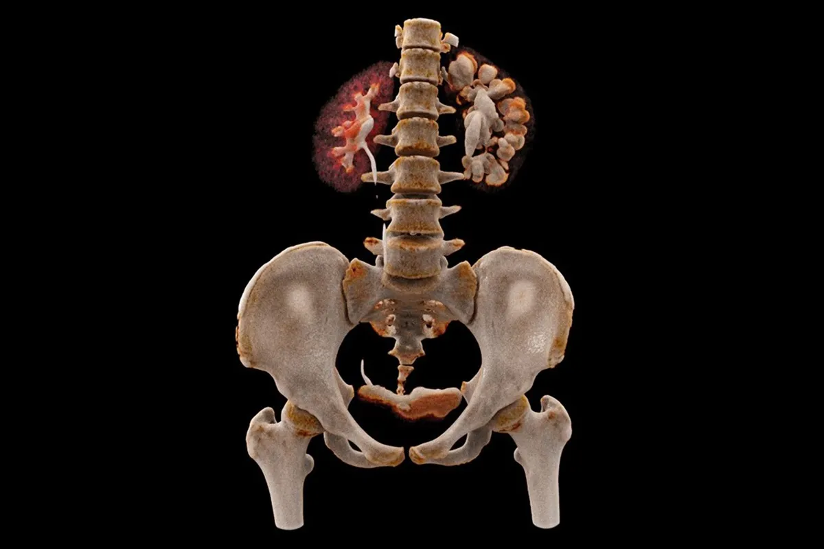 Dr Susan Shelmerdine, Consultant Paediatric Radiologist at GOSH. This image shows a three-dimensional reconstruction of the kidneys, with the right kidney having a large kidney stone, known as a 'staghorn calculus' – this is particularly striking when compared to the healthy kidney on the left. Kidney stones affect 1 in 10 people and may be caused by chronic infections or metabolic diseases. They are caused by the build-up of crystals in the kidney which forms a hard stone-like lump. The build-up of this over time can result in the gradual damage to kidney tissues. Dr Shelmerdine and her team use these reconstruction images to explain their findings in a more understandable way to their patients.