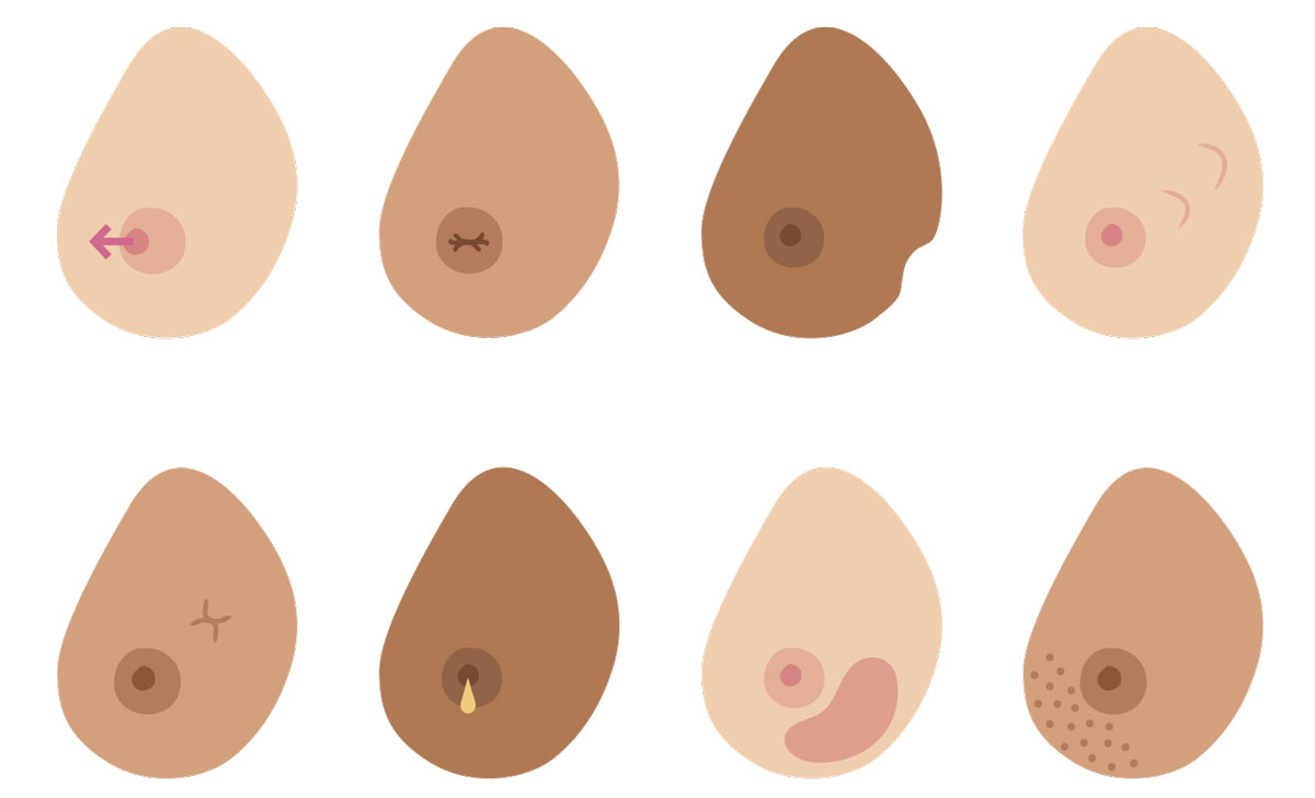 2. Shows normal and abnormal shapes of breast nipples i.e. flat and