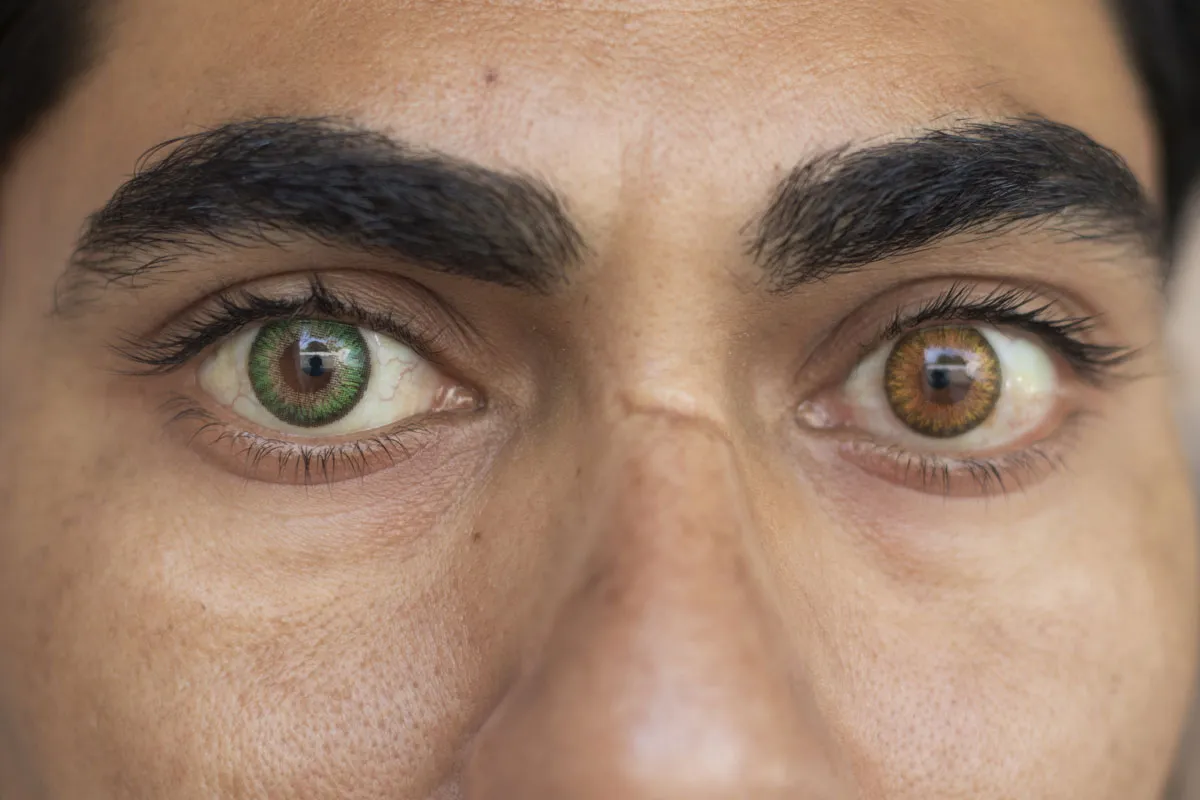 A man with Heterochromia