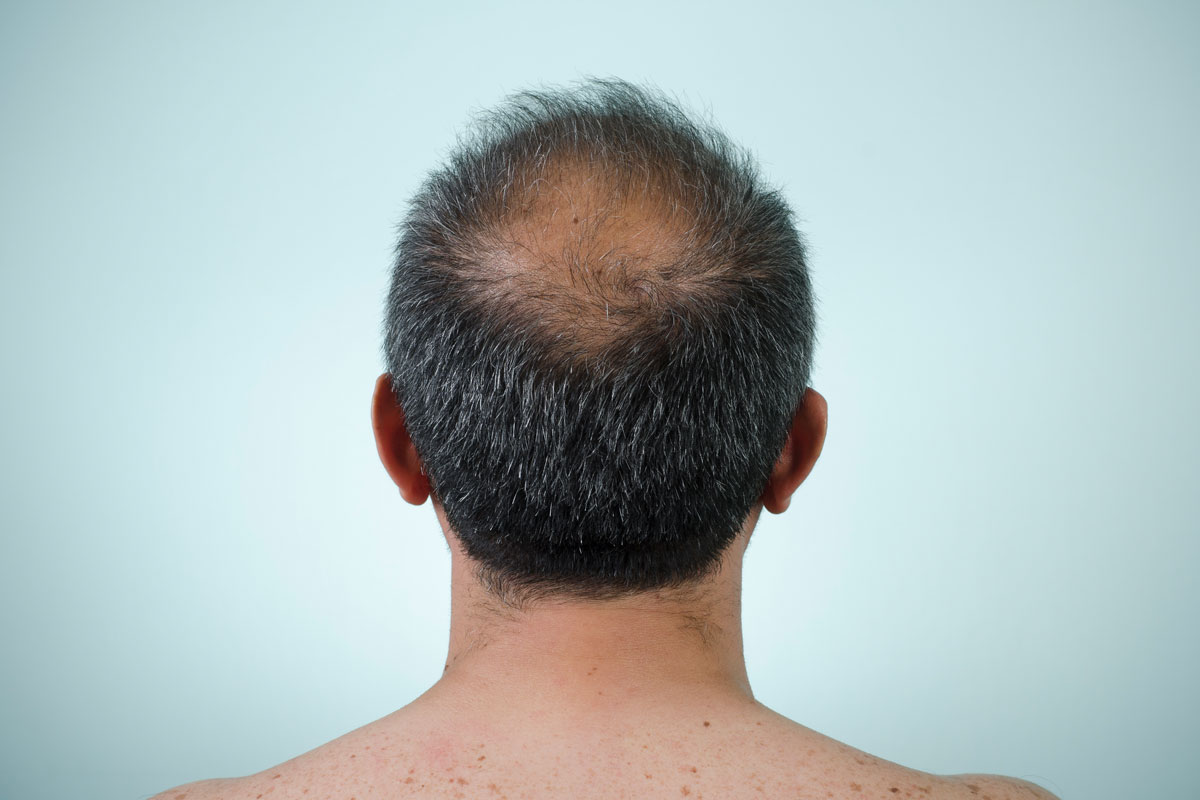 Scientists might soon cure balding. Here’s how
