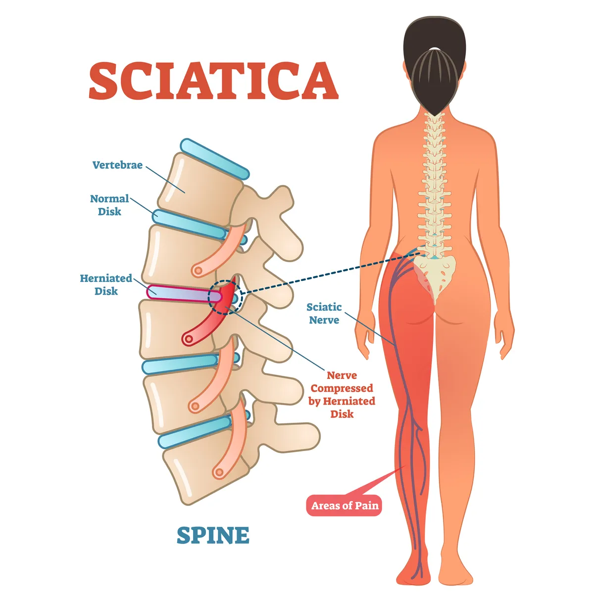 The sciatica nerve
